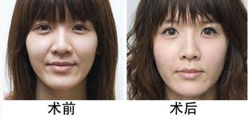 鼻唇沟对比图