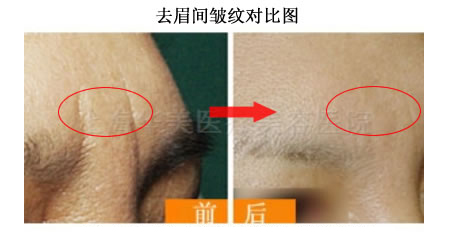 眉间纹（川子纹）对比图