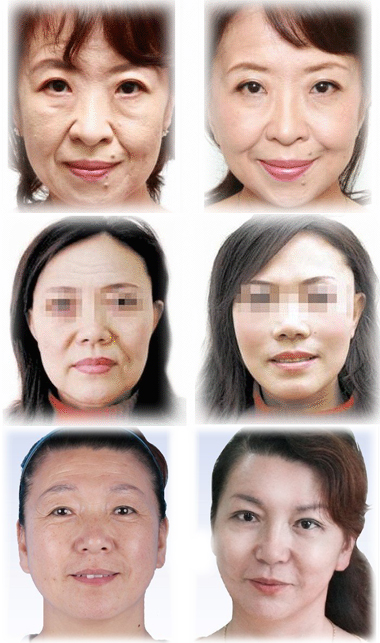 手术拉皮对比图