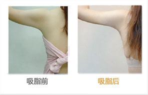 吸脂术后恢复对比图