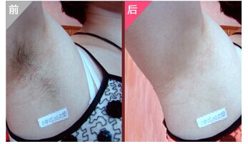 无痛脱腋毛