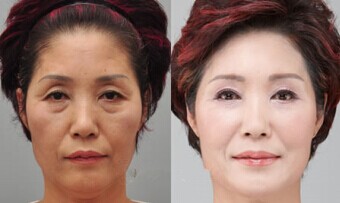 常熟专业极限音波拉皮哪家医院好