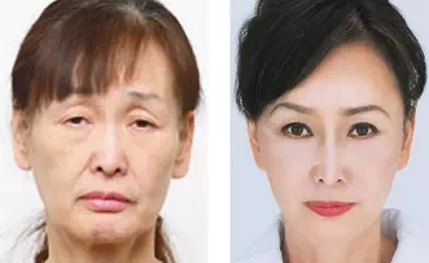 常熟做极限音波拉皮的价格是多少