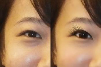 天生黑眼圈很重怎么办