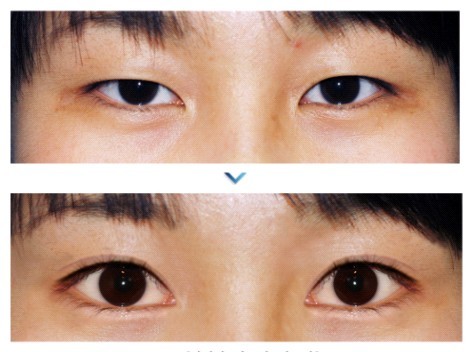 开内眼角可以使小眼变大眼吗