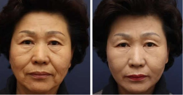 有没有不手术祛眼袋的方法