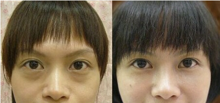 出现眼袋要怎么消除呢