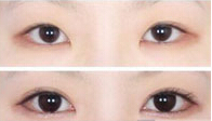 开眼角