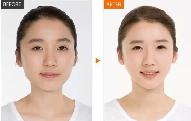 瘦脸针