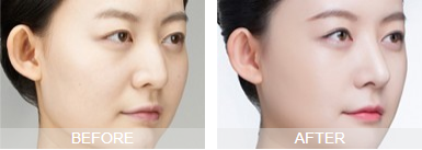 隆鼻
