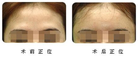 丰额头
