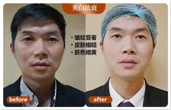 水光注射真实案例
