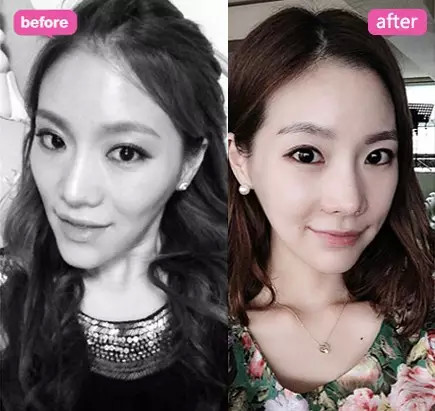 上海九院曹卫刚教授邀您见证"脂肪填充面部年轻化"