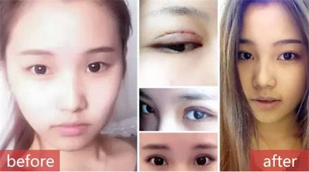 【暑期整形比较强攻略】如何以比较小的代价，获得比较高的颜值？