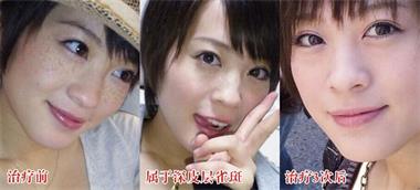 【暑期整形比较强攻略】如何以比较小的代价，获得比较高的颜值？