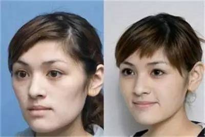 微整