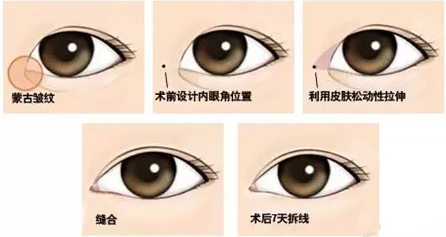 双眼皮+开眼角一块做，大眼加倍!