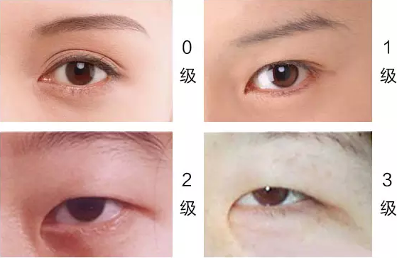 双眼皮+开眼角一块做，大眼加倍!