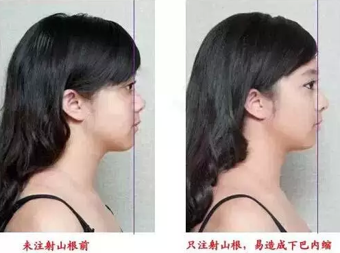 面部缺乏立体感?不是光做鼻子就能了事的!
