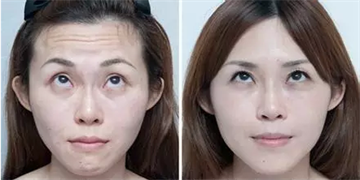 肉毒素除皱一针可以维持多久