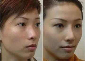 常熟做隆鼻价钱多少