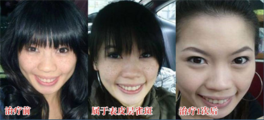 激光治疗雀斑是否安全呢